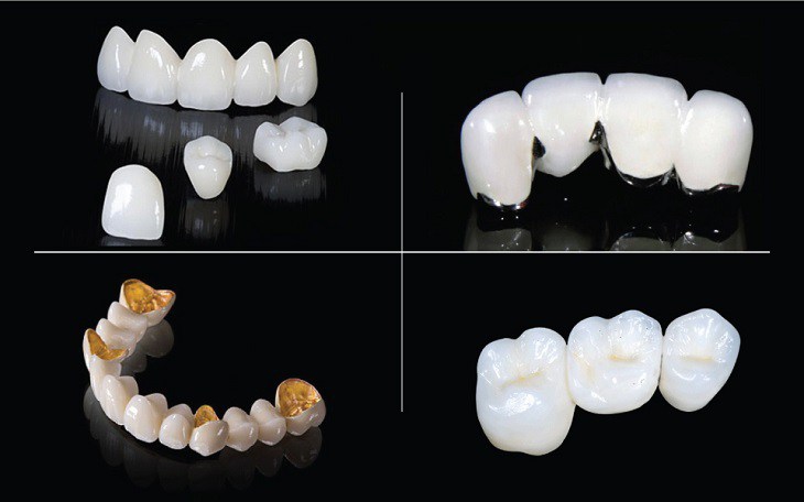 Người bệnh nên chọn những vật liệu tốt hơn như răng sứ Emax/Cercon, răng toàn sứ…