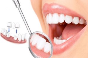 Có 3 cách trị hôi miệng khi bọc răng sứ là: Vệ sinh răng sạch sẽ, tìm đến các bác sĩ có chuyên môn giỏi và chọn vật liệu bọc răng phù hợp.