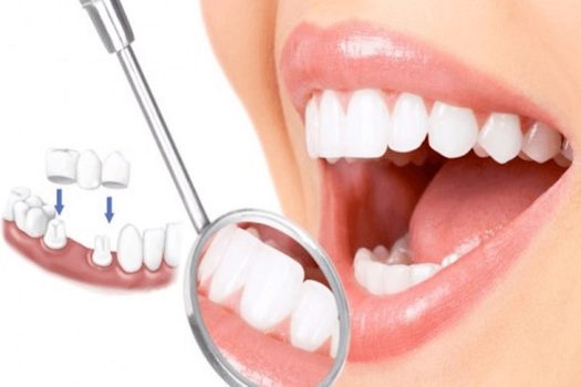 Có 3 cách trị hôi miệng khi bọc răng sứ là: Vệ sinh răng sạch sẽ, tìm đến các bác sĩ có chuyên môn giỏi và chọn vật liệu bọc răng phù hợp.