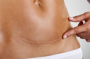[Giải Đáp] Kiêng Ăn Gì Để Không Bị Sẹo Lồi Mất Thẩm Mỹ? 