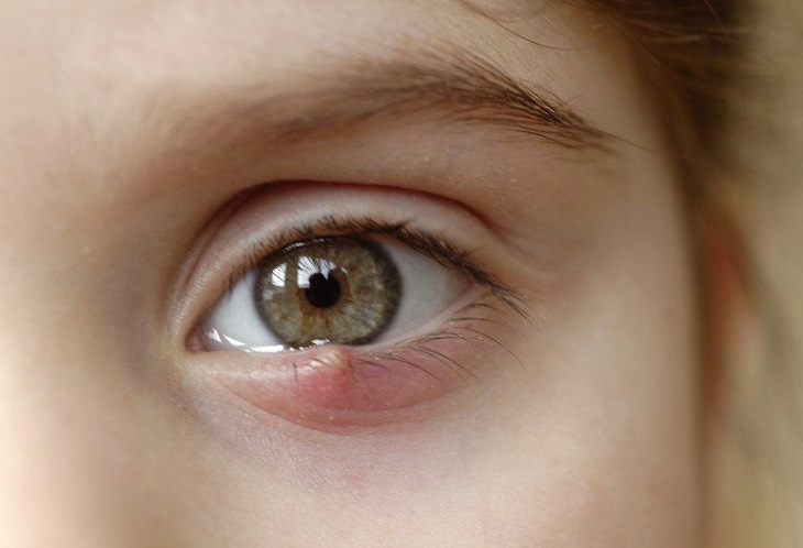 Lẹo mắt có thể chữa bằng nhiều cách trong đó dùng chỉ được nhiều người áp dụng
