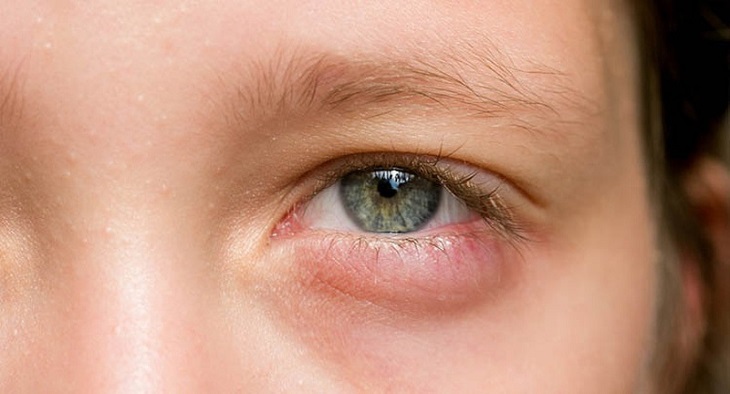 Có rất nhiều cách chữa lẹo mắt cho bé đơn giản tại nhà