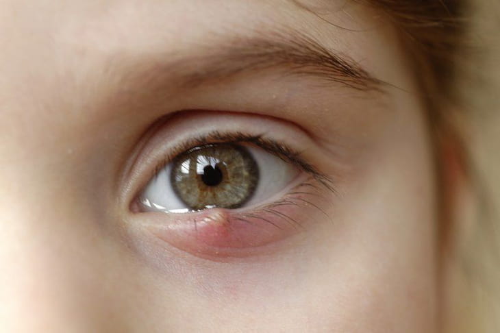Lẹo mắt khiến người bệnh cảm thấy khó chịu