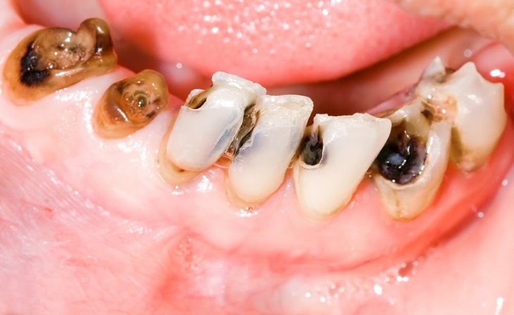 Sâu răng là một trong những tác hại phổ biến từ việc ăn quá nhiều đường