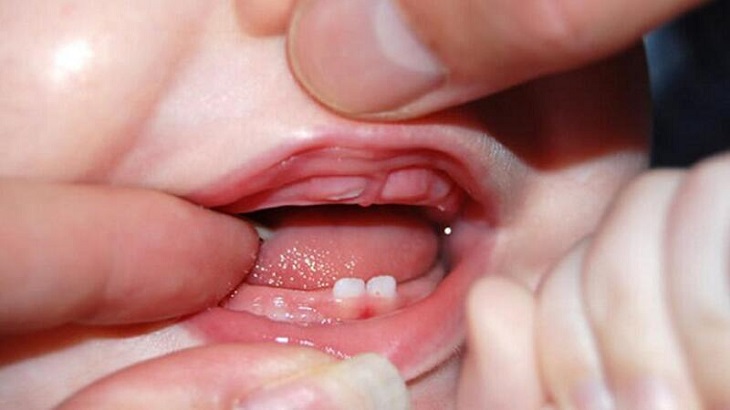 Trẻ mọc răng cũng là nguyên nhân khiến trẻ hay thức giấc lúc 3 giờ sáng