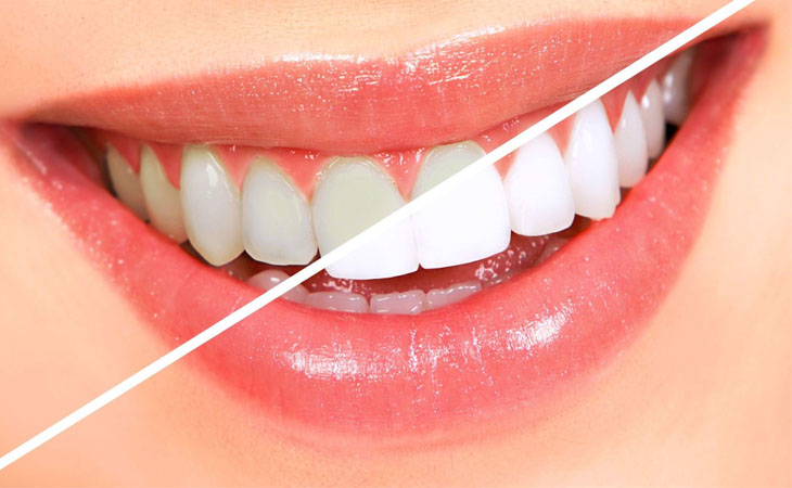 Tẩy trắng răng là phương pháp hoàn hảo nhất khắc phục tình trạng răng bị nhiễm màu