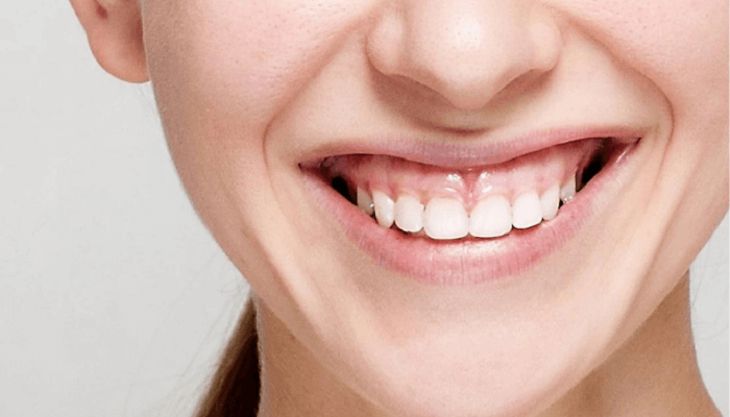 Cơ môi trên bị kéo lên quá cao khi cười là một trong những nguyên nhân gây cười hở lợi