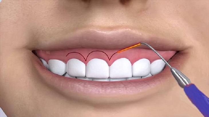 Cắt viền nướu làm dài thân răng là tiểu phẫu dễ thực hiện
