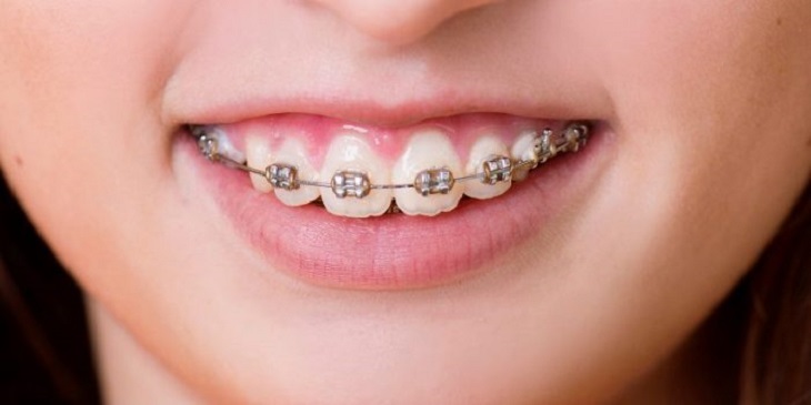 Niềng răng chỉnh nha giúp cải thiện cười hở lợi