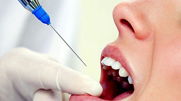 Phương pháp và chi phí điều trị cười hở lợi được rất nhiều người quan tâm