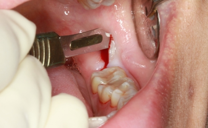 Tình trạng răng miệng người bệnh sẽ là yếu tố quyết định tới phi phí nhổ răng
