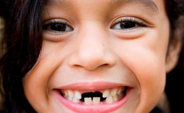 Răng lâu không mọc lại có thể gây ra những biến chứng nguy hiểm