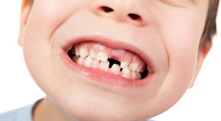 Từ 6 tuổi, răng sữa của trẻ bắt đầu rụng đi