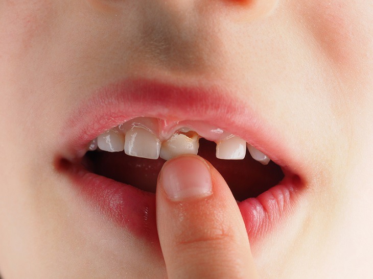 Chú ý cẩn thận khi nhổ răng cho con tại nhà