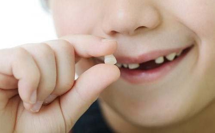 Khi răng trẻ bị sún, moc lệch cần nhổ răng sữa khi chưa lung lay
