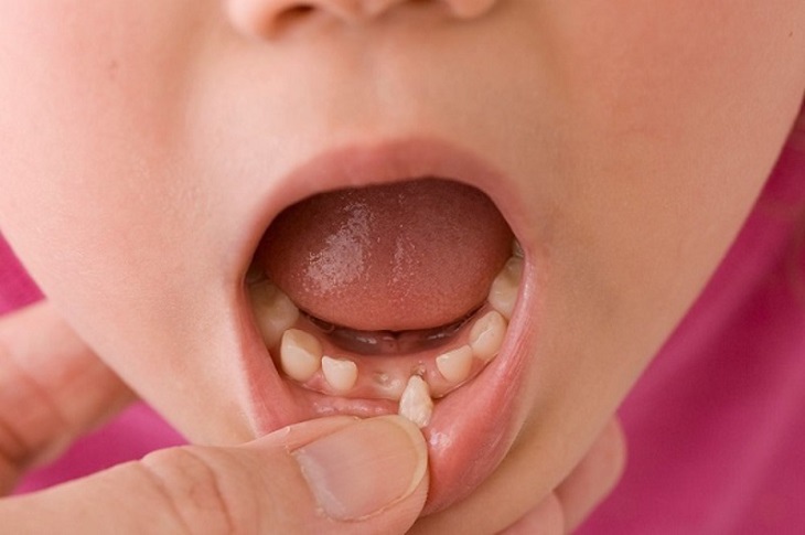 Nhổ răng không đúng cách có thể làm sót phần chân răng
