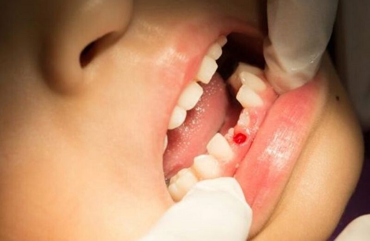 Nhổ răng sữa bị sót chân răng do nhiều nguyên nhân