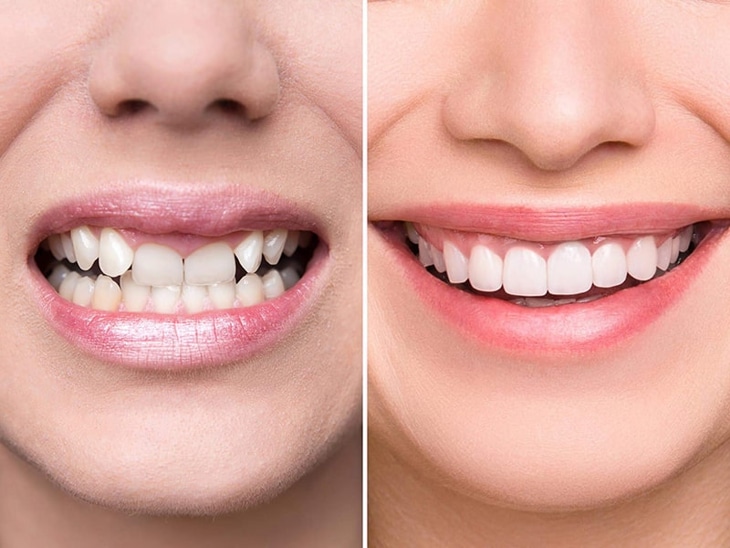 Răng sứ Venus giá bao nhiêu là băn khoăn của nhiều người