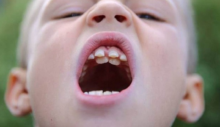 Răng trẻ mọc lẫy là tình trạng mọc lệch lạc với tiêu chuẩn thông thường