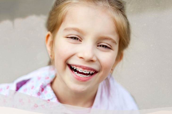 Niềng răng thường được chỉ định khi trẻ bước vào giai đoạn từ 15 - 17 tuổi
