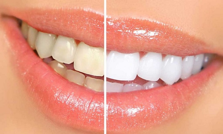 Tẩy trắng răng là một kỹ thuật phổ biến trong nha khoa hiện nay