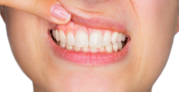 Người bị viêm lợi không nên tẩy trắng răng