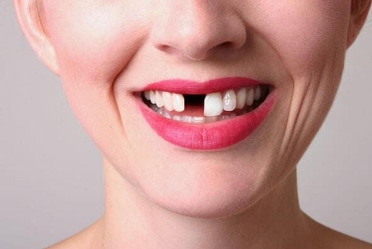 Trụ implant được dùng cho trường hợp mất một hoặc nhiều răng