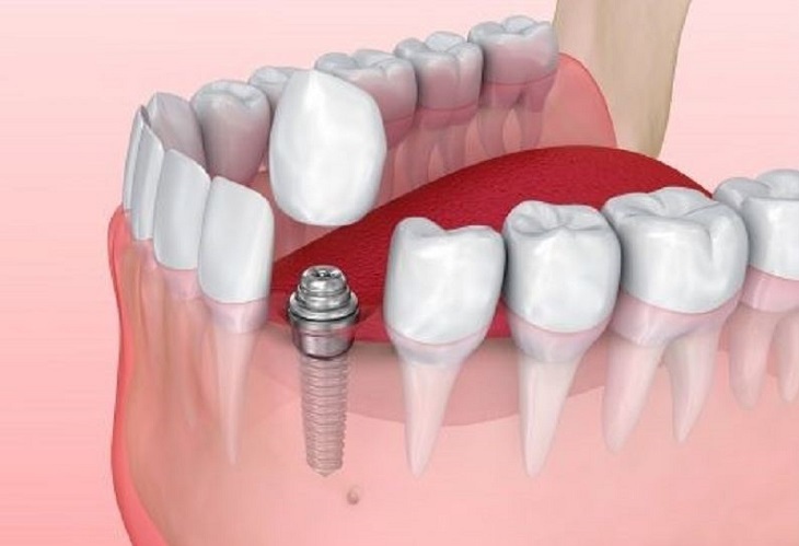 Loại trụ này thường dùng để phục hình răng, mang đến hiệu quả cao