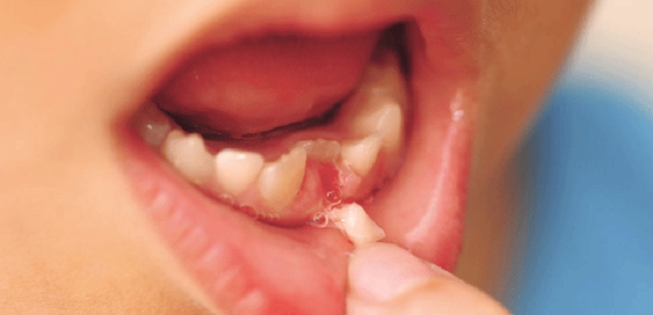 Răng sữa sẽ thay trong độ tuổi từ 5 - 12