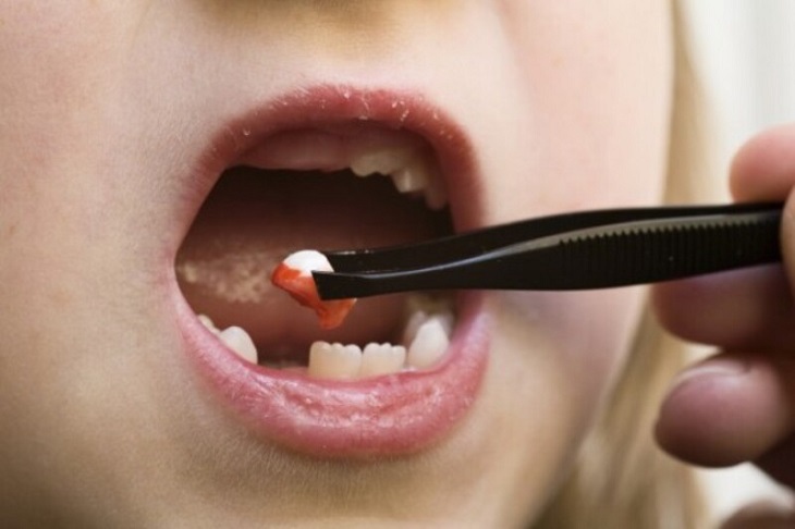 Một số trường hợp cần sự can thiệp nha khoa để nhổ răng sữa