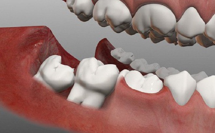 Vị trí mọc của răng có ảnh hưởng trực tiếp đến chi phí khi nhổ bỏ