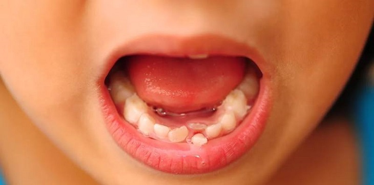 Cần chú ý đến thời điểm nhổ răng sữa mọc lệch cho trẻ
