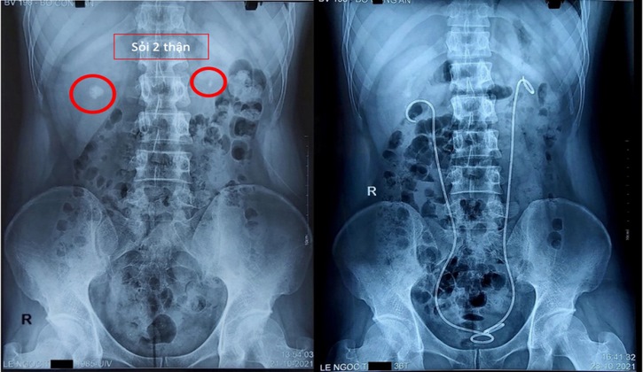 Hình ảnh chụp X-quang sỏi thận