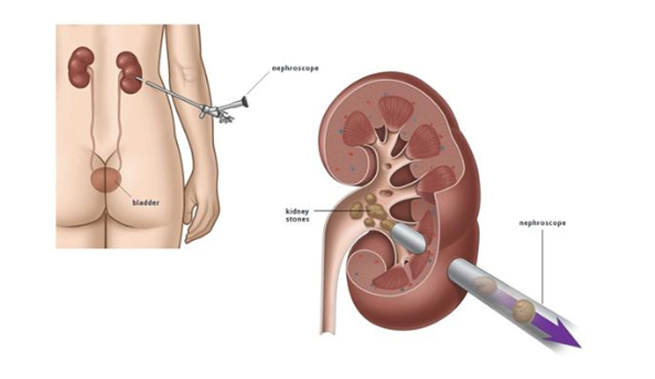 Kỹ thuật tán sỏi thận qua da nhờ sóng laser