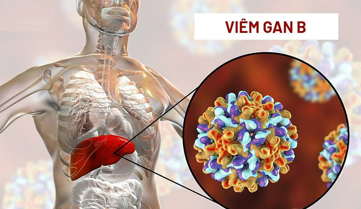 Viêm gan B hay còn gọi là viêm gan siêu vi B là 1 trong 5 loại hình thành do virus HBV