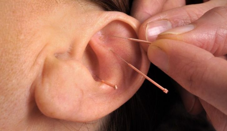 Nhĩ châm là phương pháp châm cứu tác động lên các huyệt đạo trên vành tai 