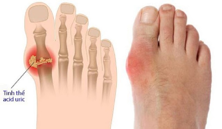 Tự nhiên đau ngón chân có thể là dấu hiệu của bệnh gout