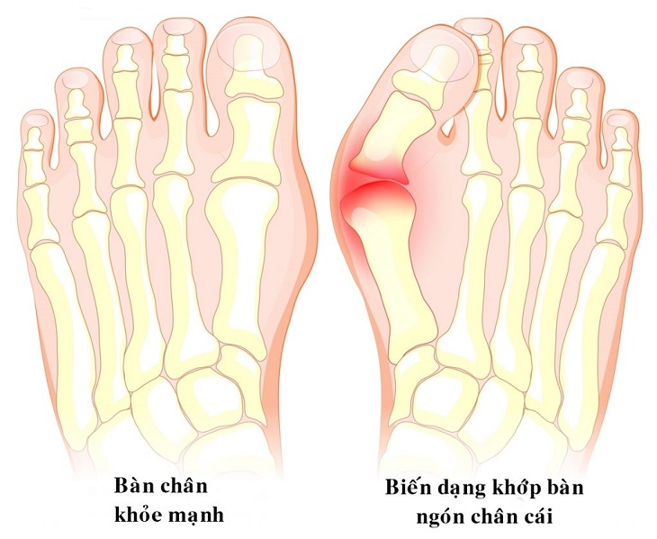 Ngón chân có thể bị biến dạng nếu không được điều trị kịp thời
