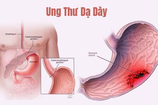 tam soat ung thu da day