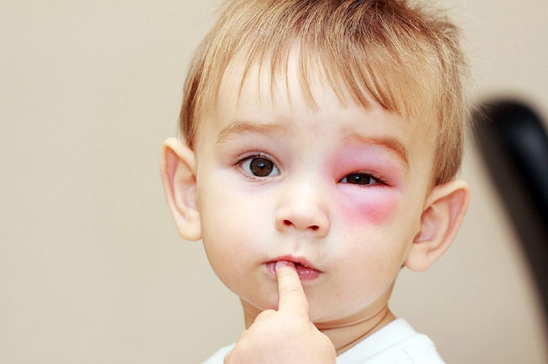 Trong một số trường hợp, việc chăm sóc không đúng cách có thể khiến con bị nổi mẩn đỏ quanh mắt.