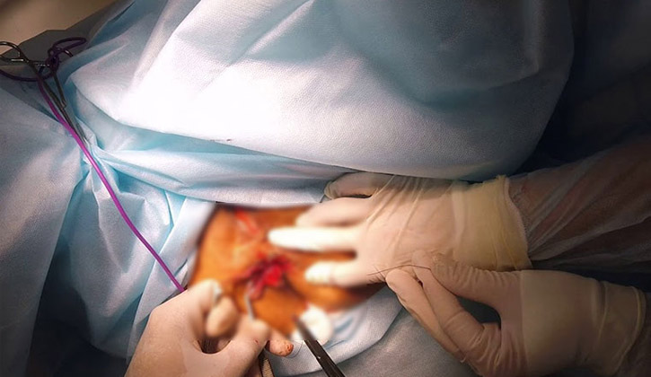 Quy trình cắt trĩ được thực hiện bởi bác sĩ chuyên môn