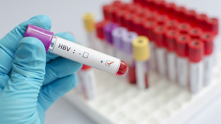 Nên xét nghiệm HBsAg để biết có bị nhiễm viêm gan B hay không