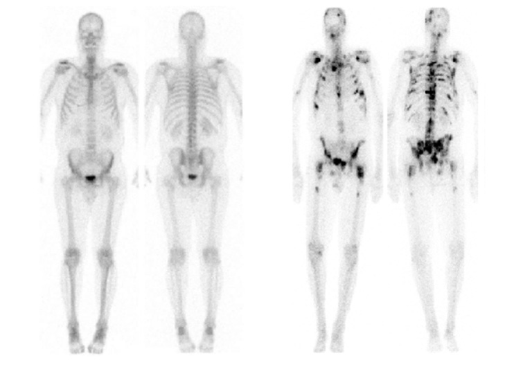 Hình ảnh xạ hình xương thu được sẽ giúp bác sĩ phát hiện các vấn đề bất thường đang xảy ra tại xương