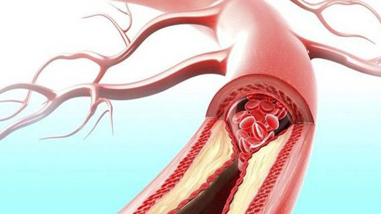 Quá trình lưu thông máu và oxy về tim bị cản trở là nguyên nhân gây đau thắt ngực không ổn định