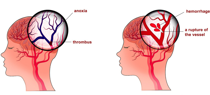 Đột quỵ còn được gọi là tai biến mạch máu não