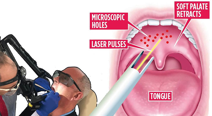 Kỹ thuật laser ngày càng dùng rộng rãi