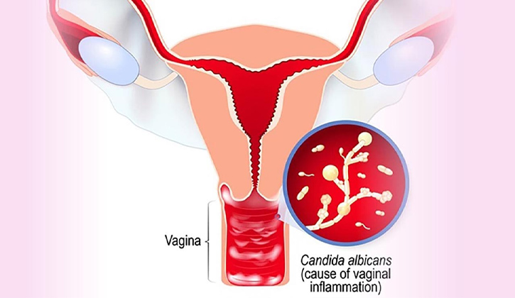 Nấm phụ khoa là bệnh lý có thể gây nguy hại đến sức khoẻ và tâm lý nữ