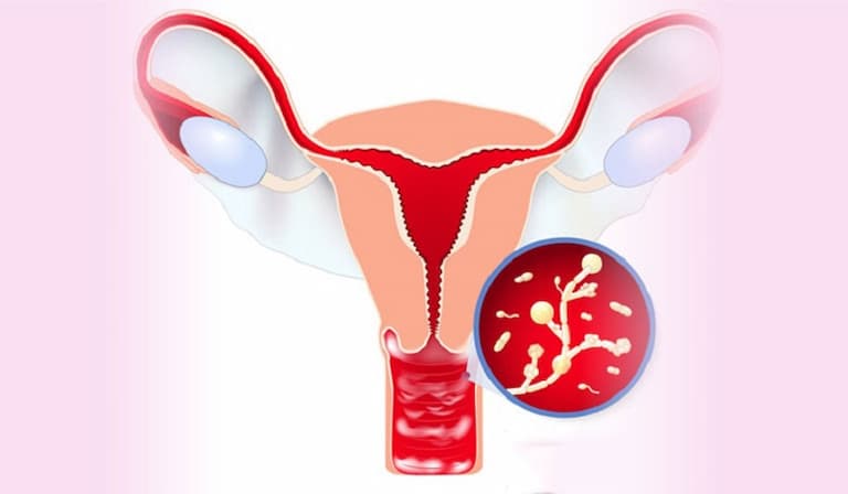 Người bị viêm vùng chậu thường khó đậu thai do tiết ra nhiều dịch âm đạo 