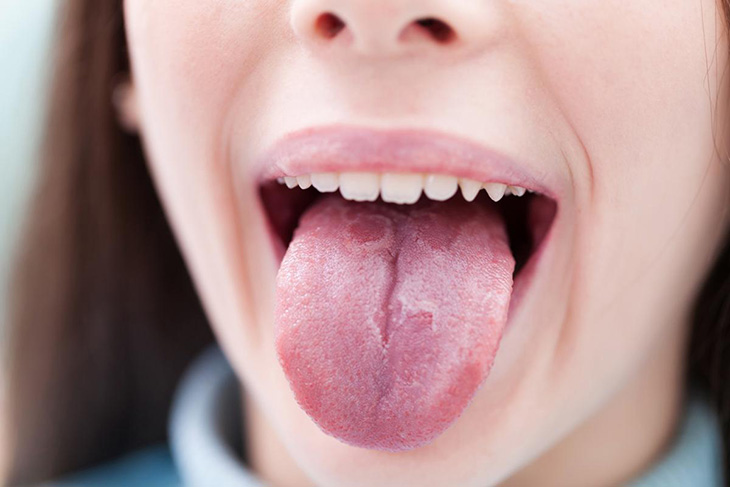 Lưỡi nổi mụn thịt là hiện tượng xuất hiện các u nhỏ nhú lên trên lưỡi