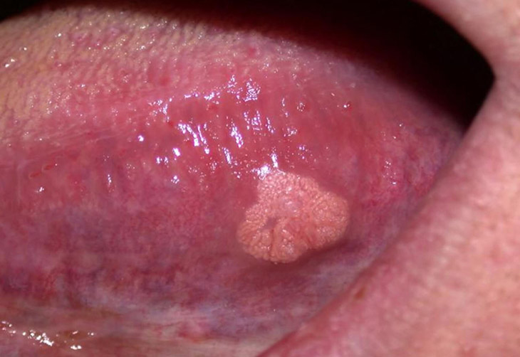 U nang bạch huyết cũng là bệnh phổ biến có biểu hiện nổi mụn thịt ở lưỡi